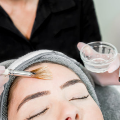 Chemical Peel