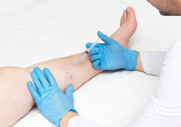 Vein Treatment