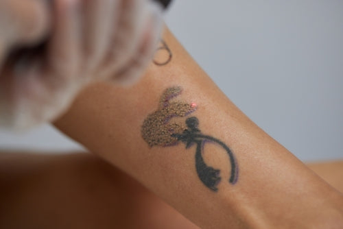 Tattoo Removal